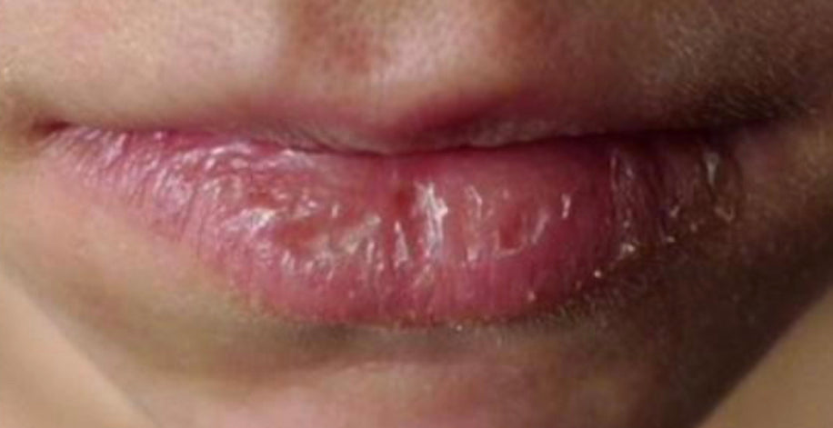 Dry Cracked Lips and Benefits of Lipgloss 
